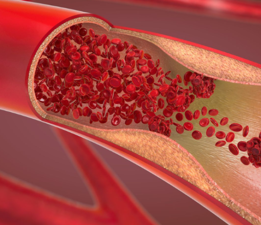 Blood Type and Your Heart Understanding the Vital Connection